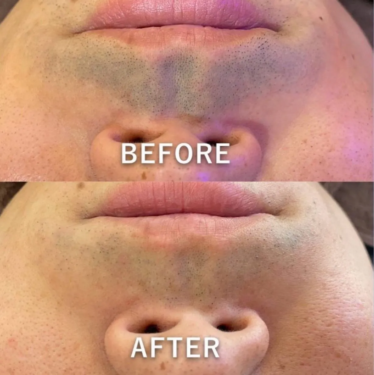 メンズヒゲ脱毛!鈴鹿/四日市