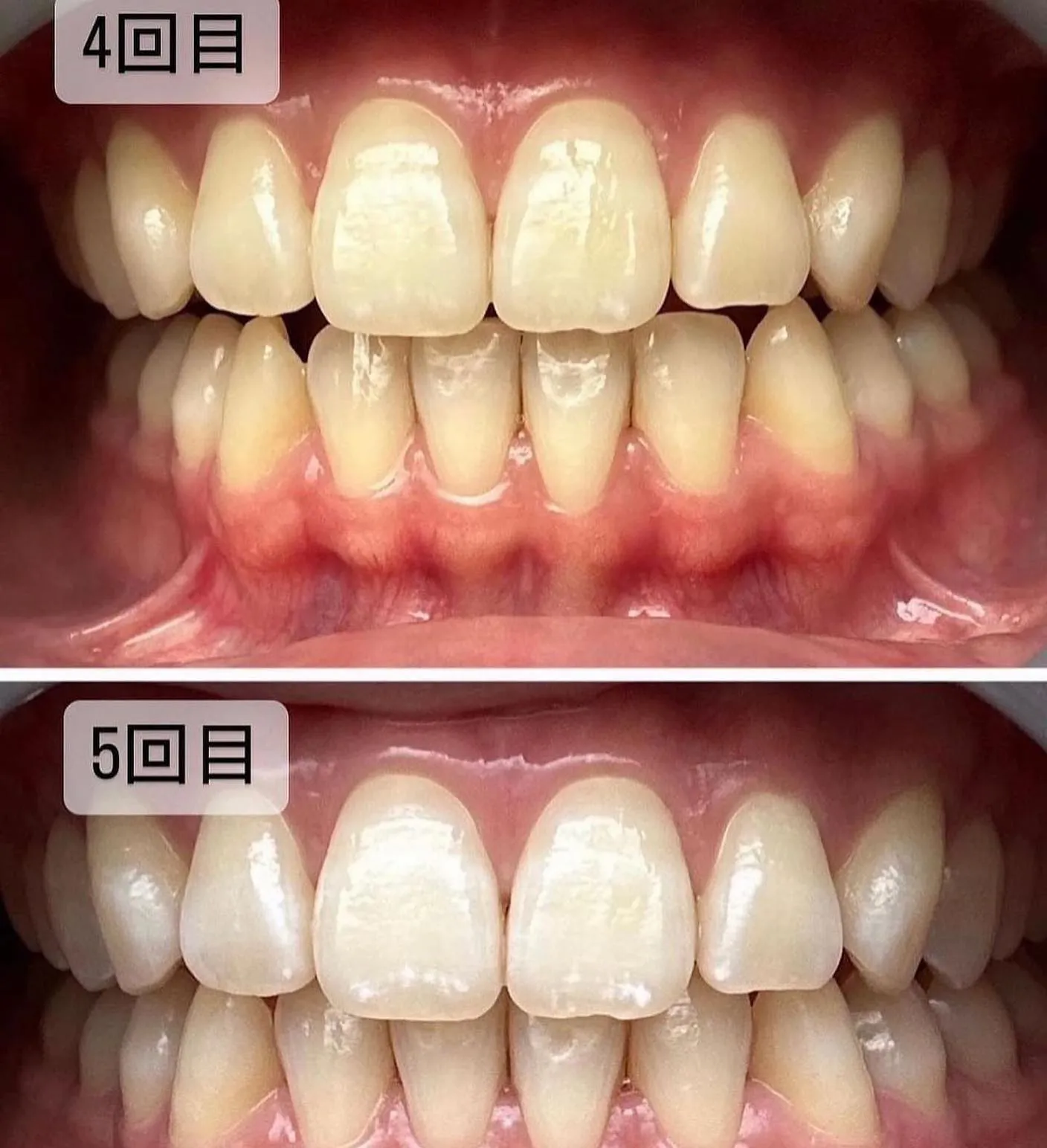 ▶︎▶︎ホワイトニング通い放題!鈴鹿/津/四日市
